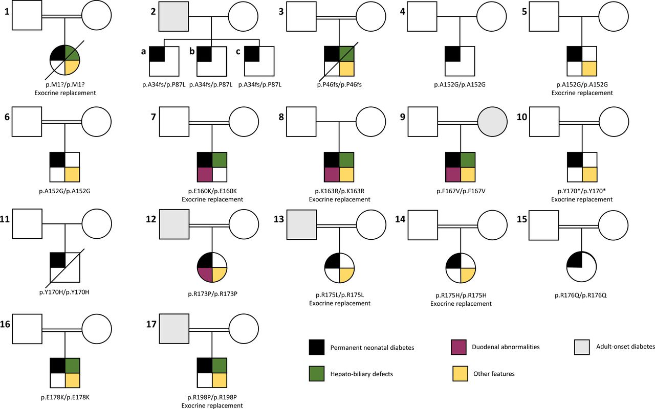 Widening the phenotypic spectrum caused by pathogenic PDX1 variants in ...