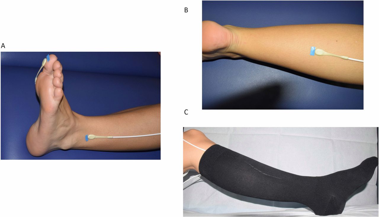 Safety of medical compression stockings in patients with diabetes